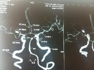RARE M2-M3 JUNCTION ANEURYSM OPERATED AT IVY HOSPITAL MOHALI BY DR VINEET SAGGAR