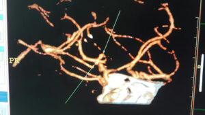 Large bilobbed MCA bifurcation aneurysm