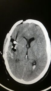 Large bilobbed MCA bifurcation aneurysm