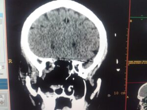 RARE SKULL BASE TUMOUR OPERATED BY Dr Vineet Saggar