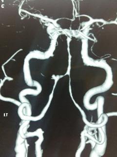 Rare vertebral artery