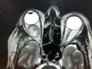 Rare Intra Orbital Tumour Operated via Supra Orbital Approach