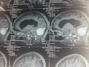 Large Posterior Fossa Meningioma Operated by Dr Vineet Saggar with Excellent Outcome