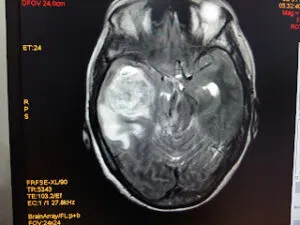 Large Temporal Mass Operated at Livasa Hospital