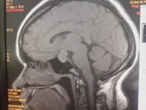 Skull Base Neurosurgery India - Dr Vineet Saggar