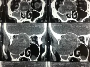 Rare Skull Base Tumour Operated at Livasa Hospital via Osteoplastic Maxillotomy Approach