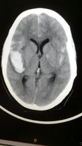 Large bilobbed MCA bifurcation aneurysm