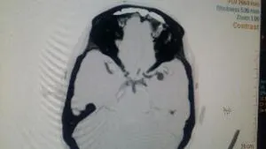 Large Wide Necked MCA Bifurcation Aneurysm Operated by Us at Livasa Hospital Mohali Chandigarh Punjab with Good Outcome