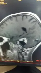 Large Acoustic Schwannoma Operated by Dr Vineet Saggar Neurosurgeon Mohali Chandigarh Punjab