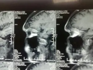 Rare Intra Orbital Tumour Operated via Supra Orbital Craniotomy Approach. Chandigarh Mohali & Punjab