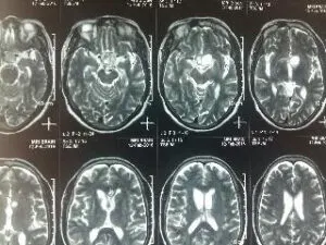 TRANSSPHENOIDAL REMOVAL OF PITUTARY MACRO ADENOMA