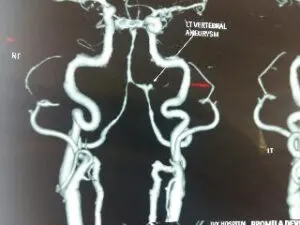 Rare Vertebral Artery - PICA Junction Aneurysm Operated by Us at Livasa Hospital Mohali with Good Outcome