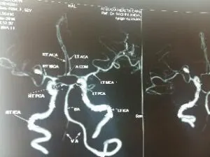 Rare M2-M3 Junction Aneurysm Operated at Livasa Hospital Mohali by Dr Vineet Saggar
