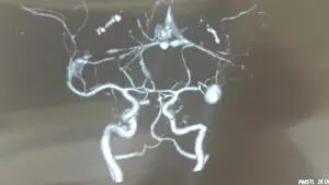 Giant Distal MCA Aneurysm (M2-M3) Junction Aneurysm Operated by Us with Good Outcome at Chandigarh Mohali Punjab