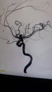Skull Base Neurosurgery India, Punjab, Chandigarh, Mohali