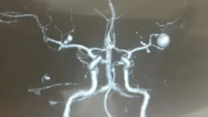 Giant Distal MCA ANEURYSM (M2-M3) junction aneurysm