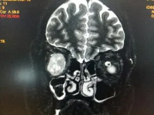 Rare Intra Orbital Tumour Operated via Supra Orbital Approach