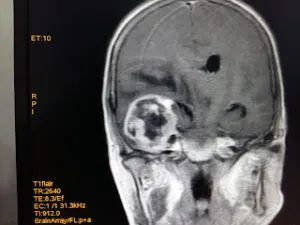 LARGE TEMPORAL MASS OPERATED AT Livasa HOSPITAL