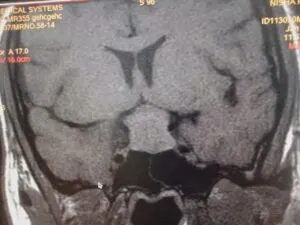 SKULL BASE NEUROSURGERY INDIA - Dr Vineet Saggar