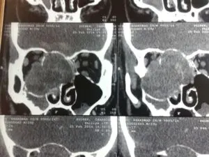 RARE SKULL BASE TUMOUR OPERATED AT Livasa HOSPITAL VIA OSTEOPLASTIC MAXILLOTOMY APPROACH
