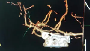 Large Bilobbed MCA Bifurcation Aneurysm Operated by Us at Livasa Hospital with Good Outcome