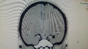 Large wide necked MCA BIFURCATION ANEURYSM operated by us at Livasa hospital mohali chandigarh punjab with good outcome