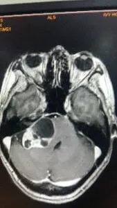 Large Acoustic Schwannoma operated by Dr Vineet Saggar Neurosurgeon mohali chandigarh punjab