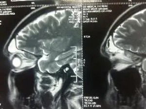 Rare Intra Orbital Tumour Operated via Supra Orbital Craniotomy Approach. Chandigarh Mohali & Punjab