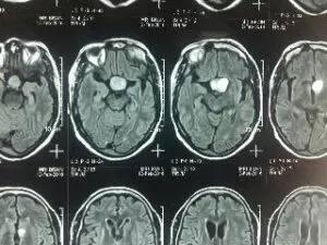 TRANSSPHENOIDAL REMOVAL OF PITUTARY MACRO ADENOMA