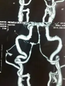 Rare vertebral artery - pica jn aneurysm operated by us at Livasa hospital mohali with good outcome