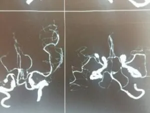 RARE M2-M3 JUNCTION ANEURYSM OPERATED AT Livasa HOSPITAL MOHALI BY DR VINEET SAGGAR