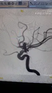 RARE ENDOVASCULAR SURGERY PERFORMED AT Livasa HOSPITAL