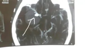 Rare LENTICULOSTRIATE ARTERY aneurysm operated by Dr Vineet Saggar