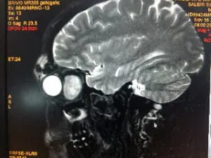 Rare Intra Orbital Tumour Operated via Supra Orbital Approach