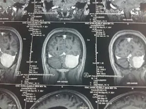 LARGE POSTERIOR FOSSA MENINGIOMA OPERATED BY DR VINEET SAGGAR WITH EXCELLENT OUT COME