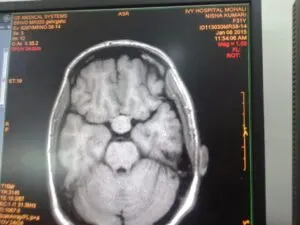 SKULL BASE NEUROSURGERY INDIA - Dr Vineet Saggar
