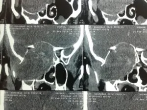 RARE SKULL BASE TUMOUR OPERATED AT Livasa HOSPITAL VIA OSTEOPLASTIC MAXILLOTOMY APPROACH