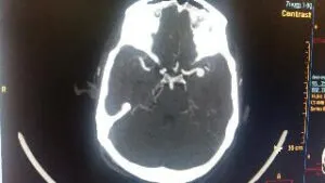 Large wide necked MCA BIFURCATION ANEURYSM operated by us at Livasa hospital mohali chandigarh punjab with good outcome