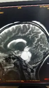 Large Acoustic Schwannoma operated by Dr Vineet Saggar Neurosurgeon mohali chandigarh punjab