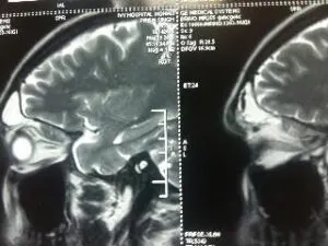 Rare Intra Orbital Tumour Operated via Supra Orbital Craniotomy Approach. Chandigarh Mohali & Punjab