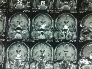 TRANSSPHENOIDAL REMOVAL OF PITUTARY MACRO ADENOMA