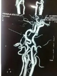 Rare vertebral artery - pica jn aneurysm operated by us at Livasa hospital mohali with good outcome