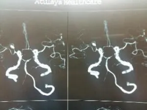 RARE M2-M3 JUNCTION ANEURYSM OPERATED AT Livasa HOSPITAL MOHALI BY DR VINEET SAGGAR