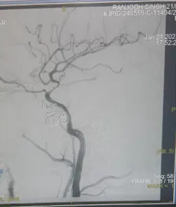 SKULL BASE NEUROSURGERY INDIA ,PUNJAB, CHANDIGARH, MOHALI