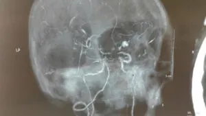 Rare LENTICULOSTRIATE ARTERY aneurysm operated by Dr Vineet Saggar