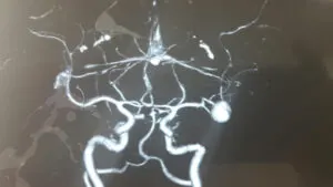 Giant Distal MCA ANEURYSM (M2-M3) junction aneurysm