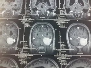 LARGE POSTERIOR FOSSA MENINGIOMA OPERATED BY DR VINEET SAGGAR WITH EXCELLENT OUT COME
