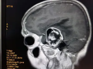LARGE TEMPORAL MASS OPERATED AT Livasa HOSPITAL