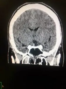 POST OPERATIVE SCAN SHOWING ALMOST COMPLETE TUMOUR REMOVAL WITH SMALL TUMOR REMENENT ON RIGHT SIDE