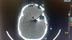 Large wide necked MCA BIFURCATION ANEURYSM operated by us at Livasa hospital mohali chandigarh punjab with good outcome